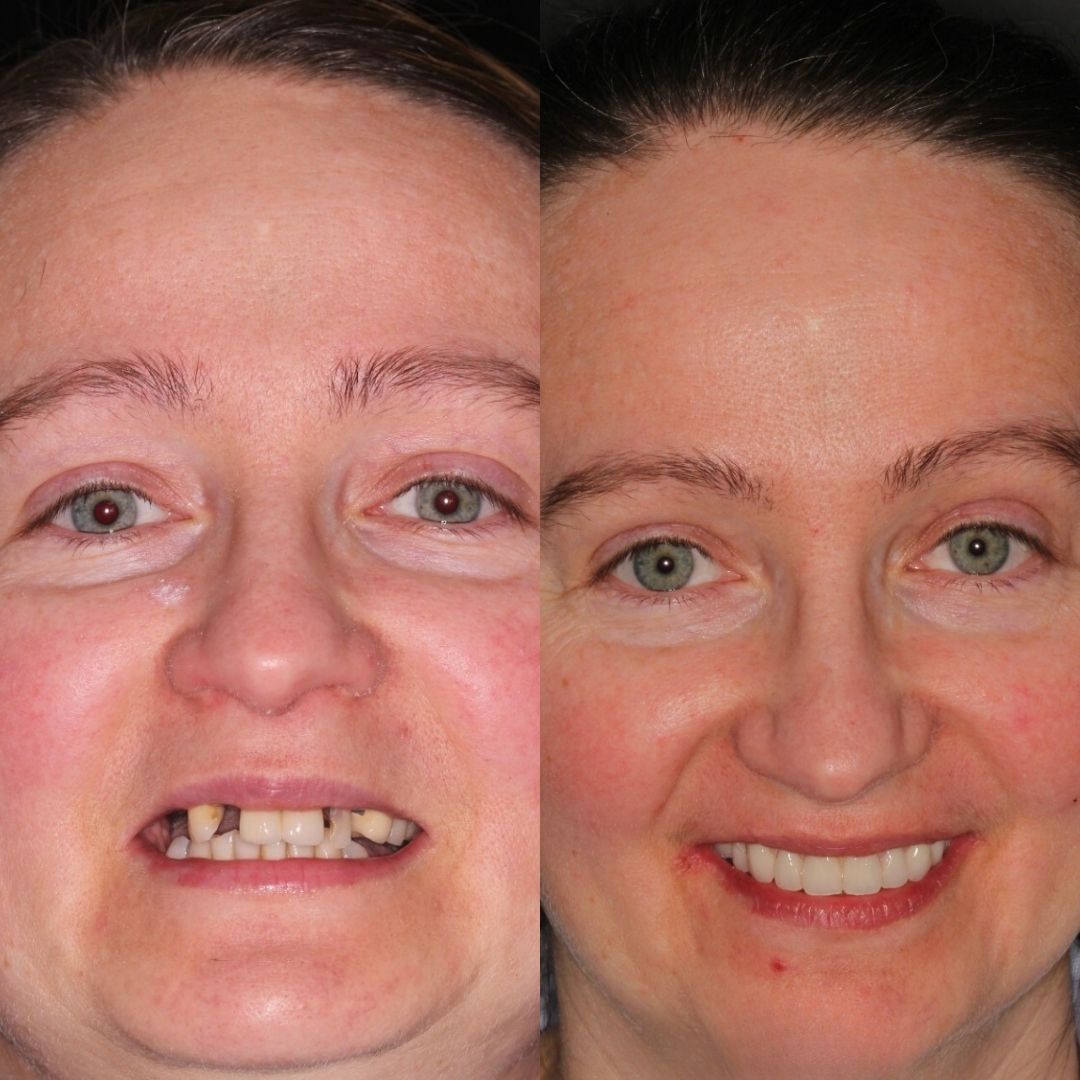 Before and after dental implant treatment with Nik Vourakis
